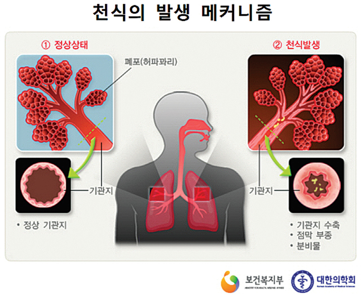 앨러지 비염과 천식 요인을 줄이는 방법