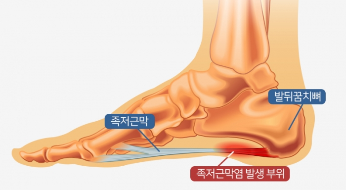 <뒤꿈치 통증 치료> 5